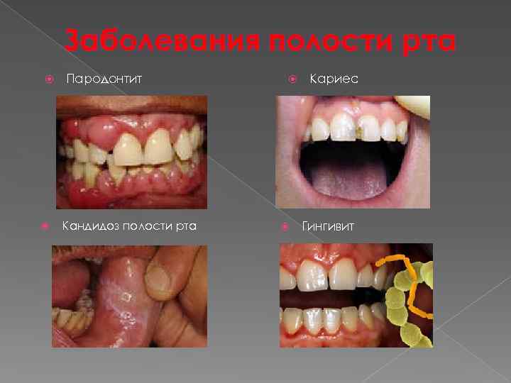 Заболевания полости рта Пародонтит Кандидоз полости рта Кариес Гингивит 