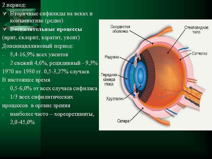 2 период: Ú Вторичные сифилиды на веках и конъюнктиве (редко) Ú Воспалительные процессы (ирит,