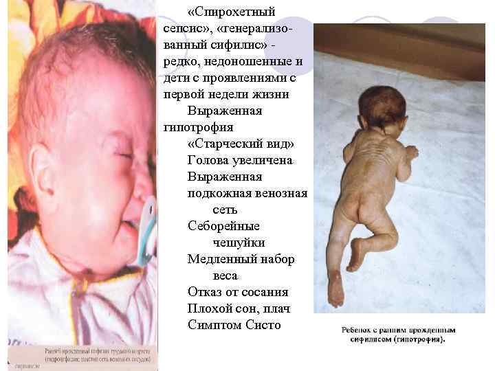  «Спирохетный сепсис» , «генерализованный сифилис» редко, недоношенные и дети с проявлениями с первой