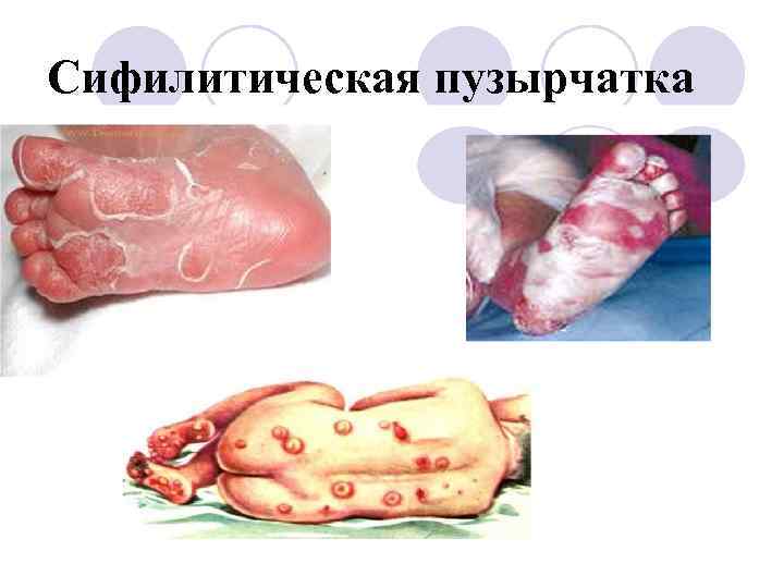 Сифилитическая пузырчатка 