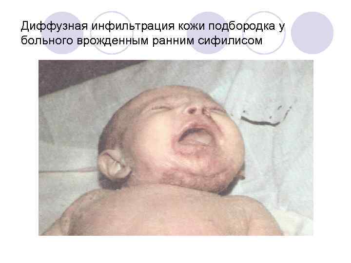 Диффузная инфильтрация кожи подбородка у больного врожденным ранним сифилисом 