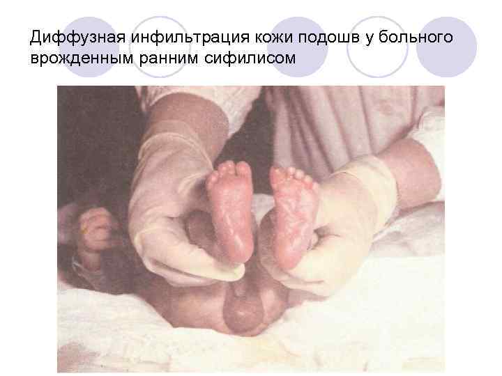 Диффузная инфильтрация кожи подошв у больного врожденным ранним сифилисом 