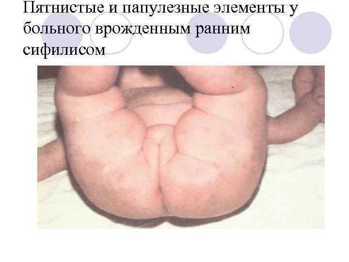 Пятнистые и папулезные элементы у больного врожденным ранним сифилисом 