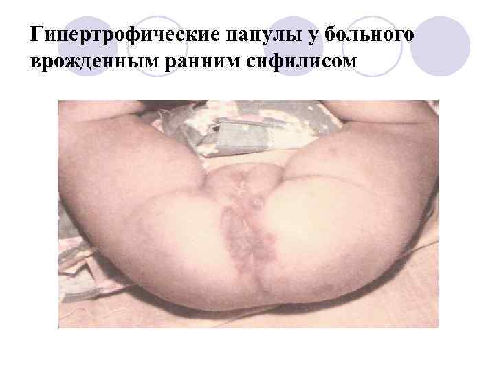 Гипертрофические папулы у больного врожденным ранним сифилисом 