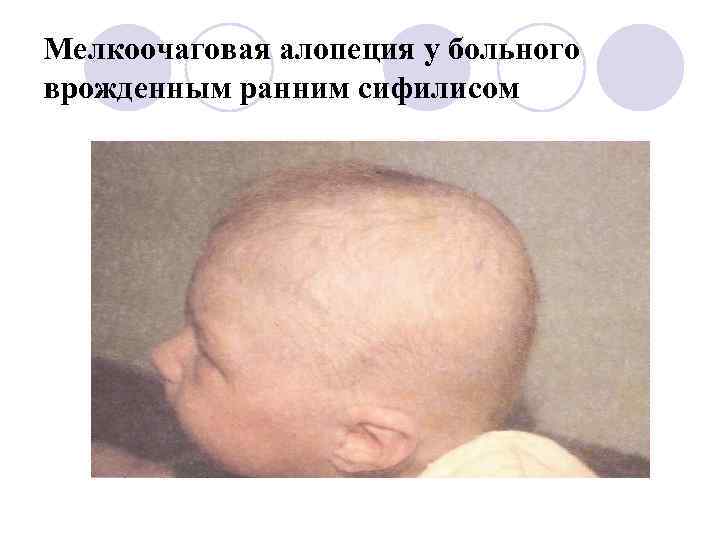 Мелкоочаговая алопеция у больного врожденным ранним сифилисом 