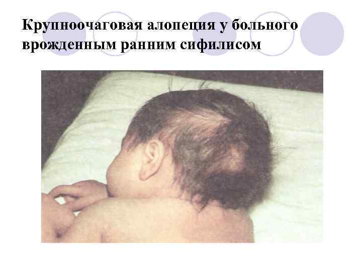 Крупноочаговая алопеция у больного врожденным ранним сифилисом 
