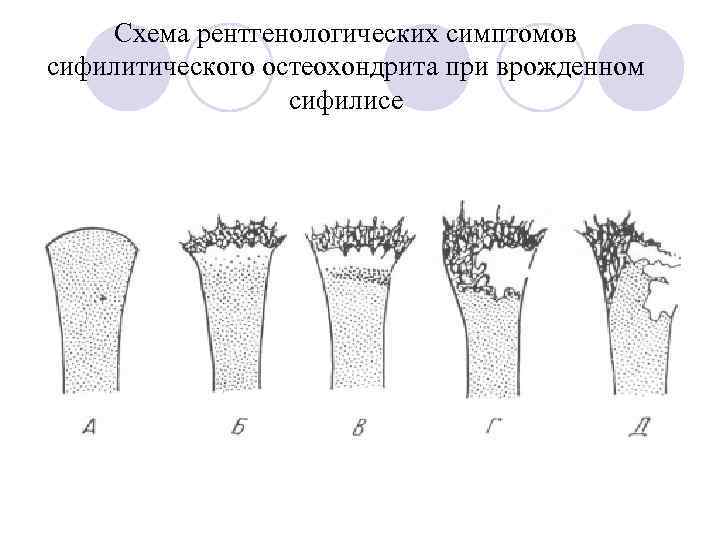 Схема рентгенологических симптомов сифилитического остеохондрита при врожденном сифилисе 