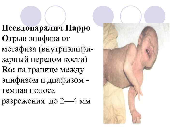 Псевдопаралич Парро Отрыв эпифиза от метафиза (внутриэпифизарный перелом кости) Ro: на границе между эпифизом