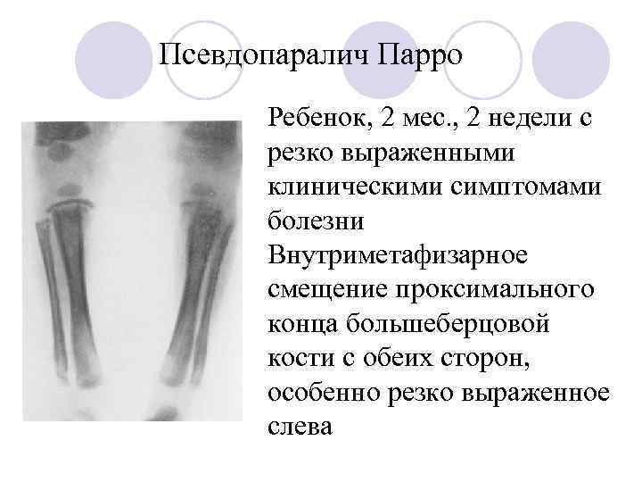 Псевдопаралич Парро Ребенок, 2 мес. , 2 недели с резко выраженными клиническими симптомами болезни