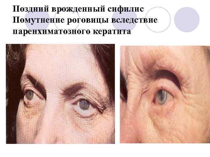 Поздний врожденный сифилис Помутнение роговицы вследствие паренхиматозного кератита 