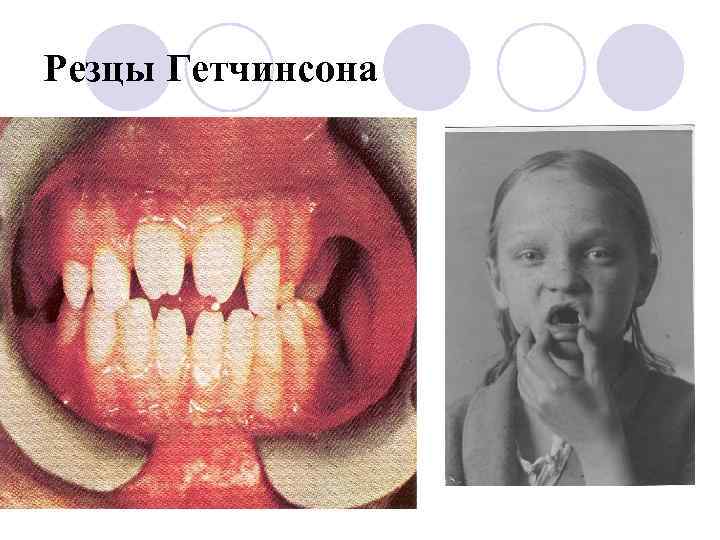 Резцы Гетчинсона 