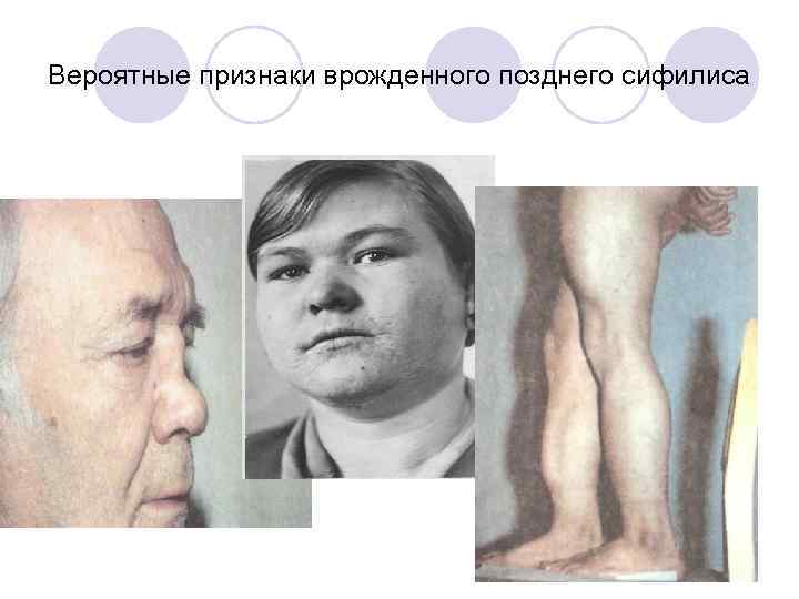 Вероятные признаки врожденного позднего сифилиса 