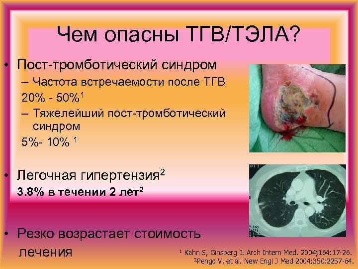 Чем опасны ТГВ/ТЭЛА? • Пост-тромботический синдром – Частота встречаемости после ТГВ 20% - 50%1