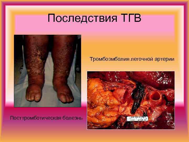 Последствия ТГВ Тромбоэмболия легочной артерии Посттромботическая болезнь 
