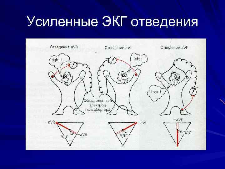Усиленные ЭКГ отведения 