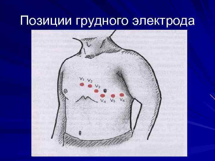 Позиции грудного электрода 