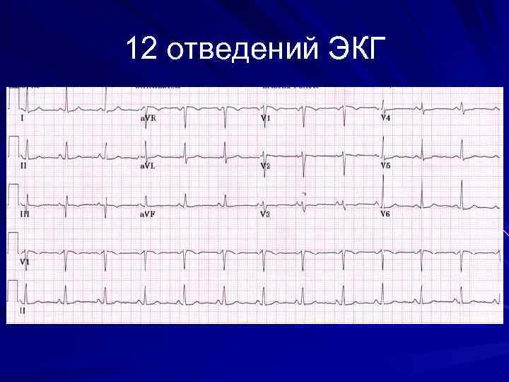 12 отведений ЭКГ 