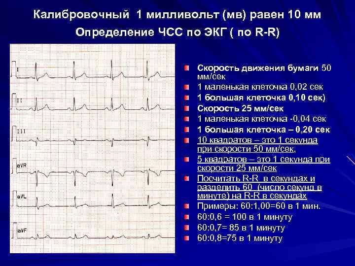 Калибровочный 1 милливольт (мв) равен 10 мм Определение ЧСС по ЭКГ ( по R-R)