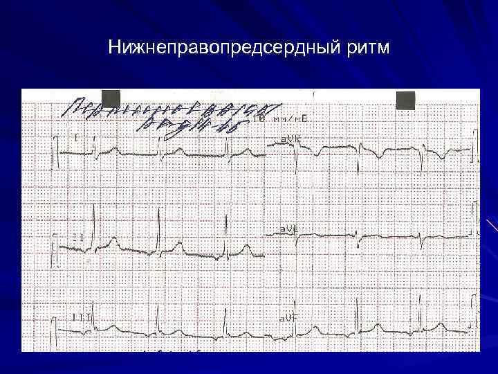 Нижнеправопредсердный ритм 