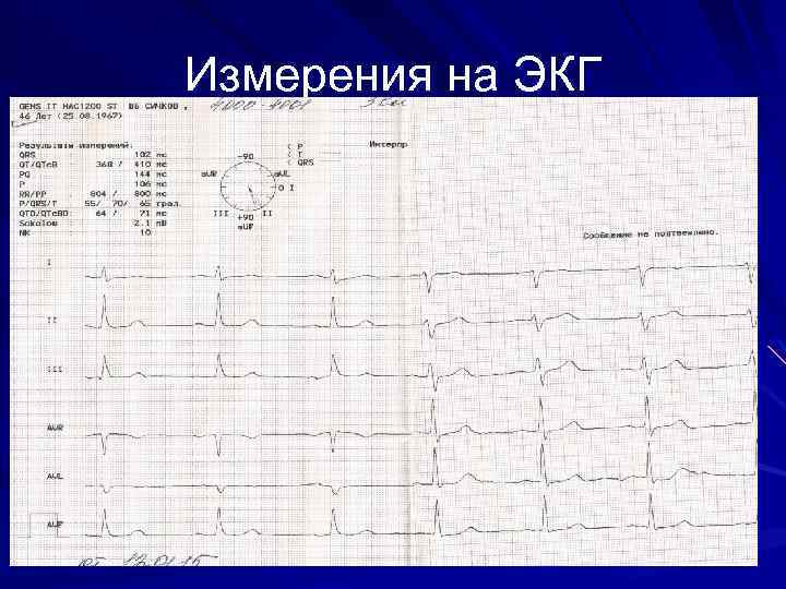 Диаграмма экг расшифровка