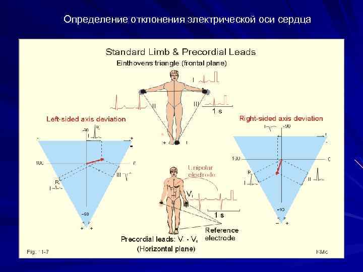 Определение отклонения электрической оси сердца 