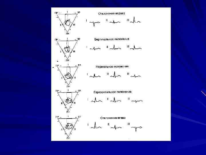 Определение положения электрической оси сердца По характеристике амплитуд значений QRS в 1, 2, 3