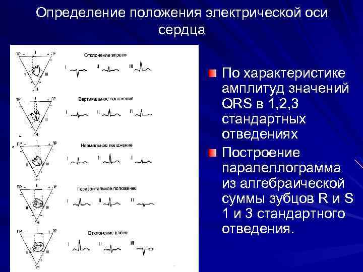 Определение положения электрической оси сердца (электрическая ось сердца совпадает с наибольшим зубцом комплекса в