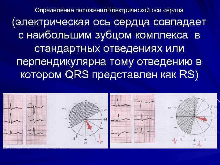 Правило паралеллограмма Алгебраическая сумма зубцов в 1 стандартном +10 мм Сумма зубцов в 3