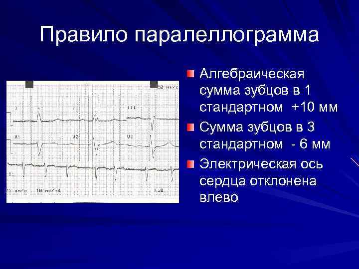 Определение синусового ритма Синусовый узел расположен субэпикардиально в правом предсердии устья полых вен 10