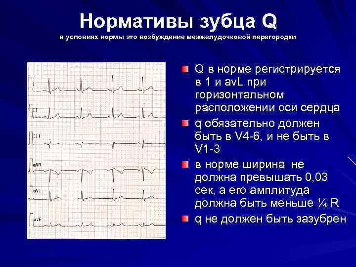 Нормативы зубцов R в условиях нормы это возбуждение миокарда правого и левого делудочков R