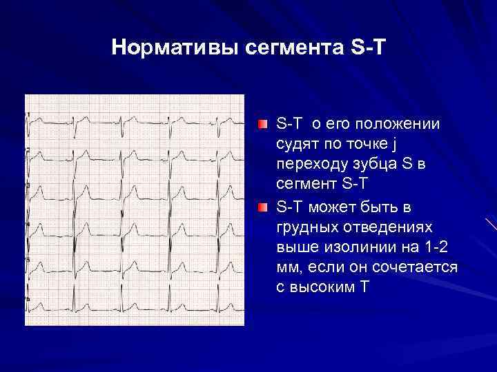 Характеристика зубца Т в норме Форма Конкордантность зубцу R или наибольшему зубцу R или