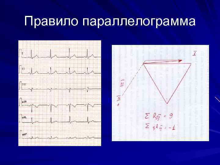 Оси отведений в треугольнике Эйтховена 