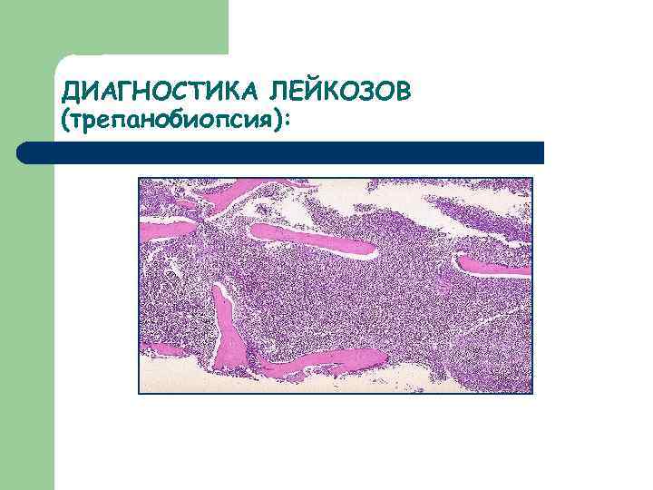 Гемобластозы патологическая анатомия презентация