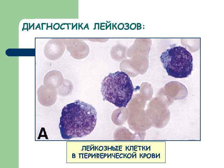 Диагностика лейкоза. Лабораторная диагностика лейкозов. Методы исследования при миелолейкозе. Острый миелобластный лейкоз лабораторная диагностика. Хронический лейкоз диагностика.