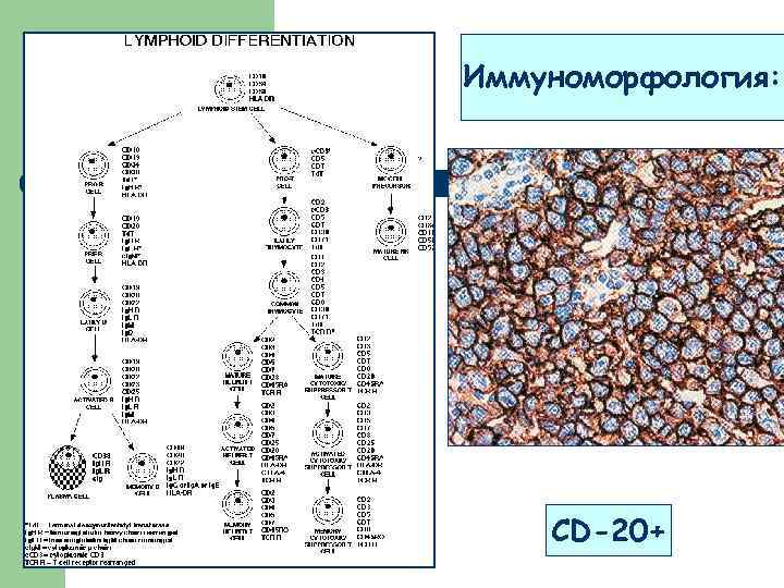 Иммуноморфология: CD-20+ 