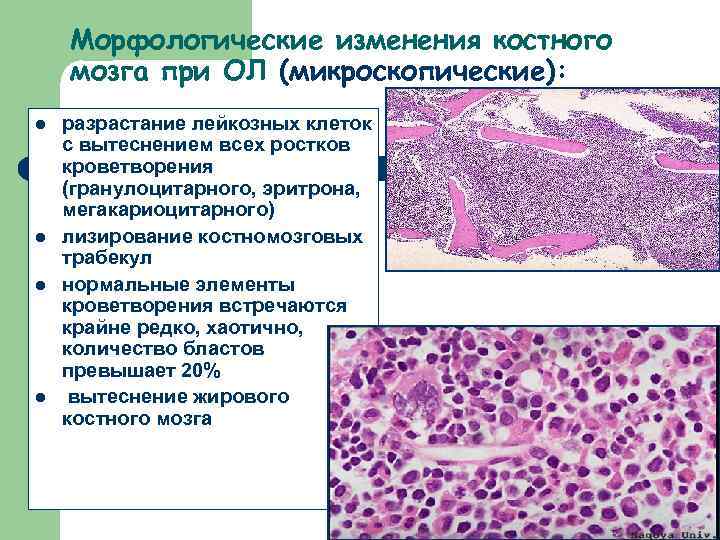 Морфологические изменения костного мозга при ОЛ (микроскопические): l l разрастание лейкозных клеток с вытеснением