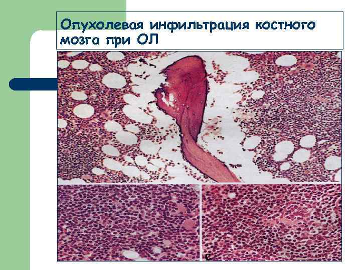 Опухолевая инфильтрация костного мозга при ОЛ 