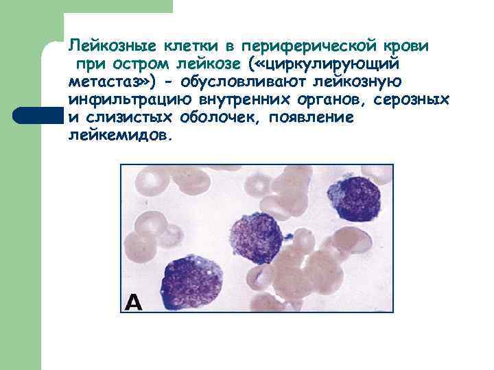Лейкозные клетки в периферической крови при остром лейкозе ( «циркулирующий метастаз» ) - обусловливают