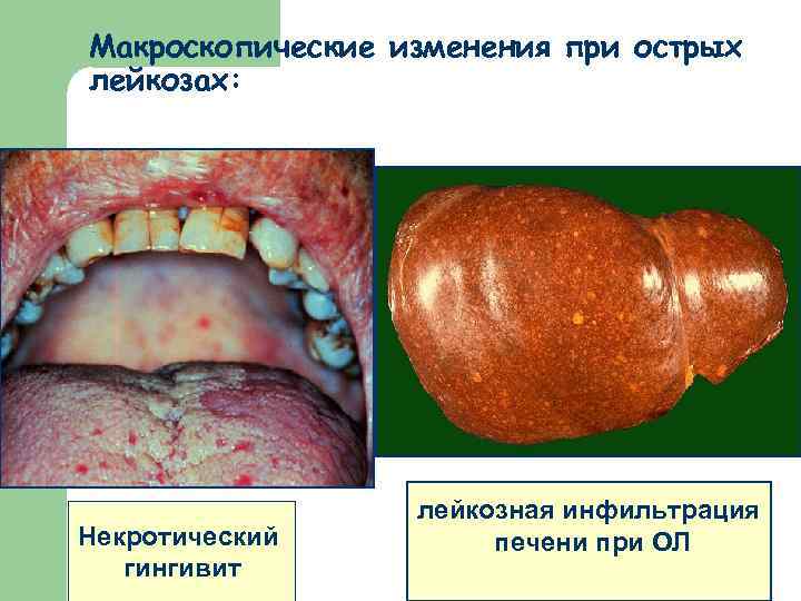 Макроскопические изменения при острых лейкозах: Некротический гингивит лейкозная инфильтрация печени при ОЛ 