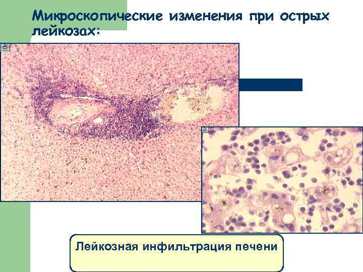 Микроскопические изменения при острых лейкозах: Лейкозная инфильтрация печени 