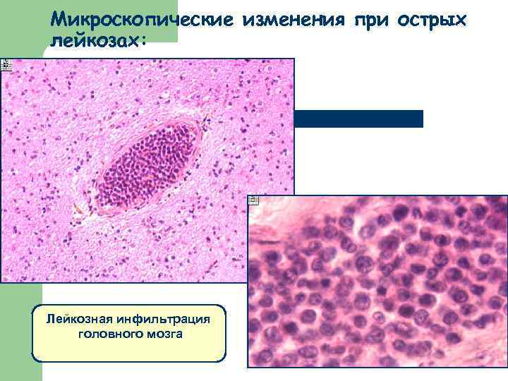 Микроскопические изменения при острых лейкозах: Лейкозная инфильтрация головного мозга 