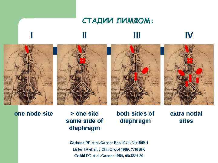 СТАДИИ ЛИМФОМ: I one node site II III > one site same side of