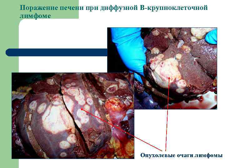 Поражение печени при диффузной В-крупноклеточной лимфоме Опухолевые очаги лимфомы 