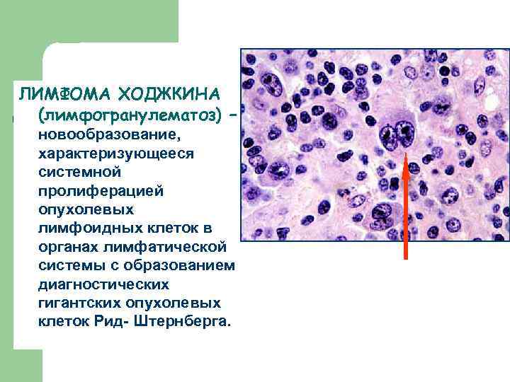 ЛИМФОМА ХОДЖКИНА (лимфогранулематоз) – новообразование, характеризующееся системной пролиферацией опухолевых лимфоидных клеток в органах лимфатической