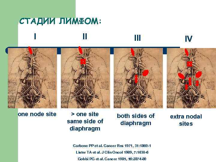 СТАДИИ ЛИМФОМ: I one node site II III > one site same side of