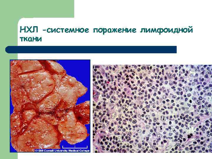 НХЛ -системное поражение лимфоидной ткани 