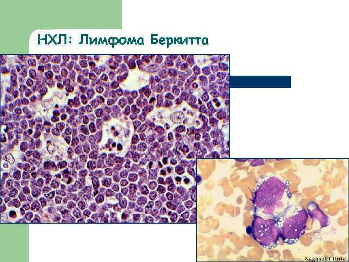 НХЛ: Лимфома Беркитта 