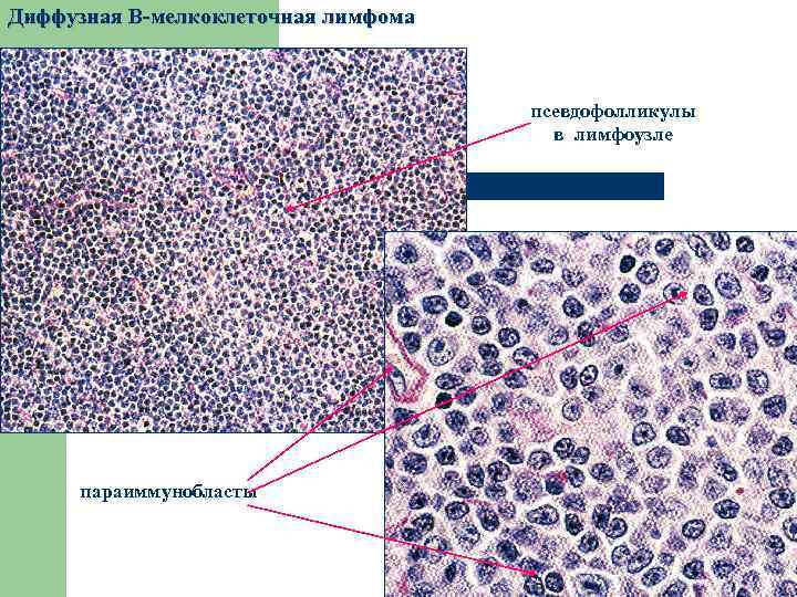 Диффузная В-мелкоклеточная лимфома псевдофолликулы в лимфоузле параиммунобласты 
