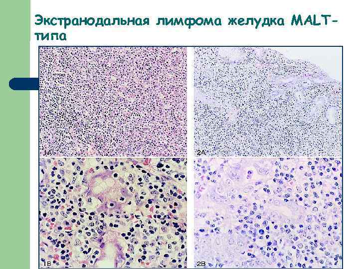 Экстранодальная лимфома желудка MALTтипа 