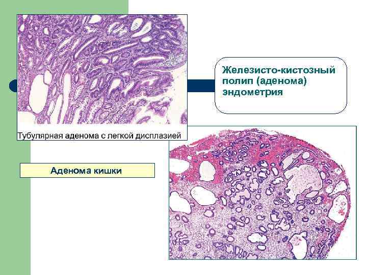 Железистый рак эндометрия. Железисто кистозный полип. Фиброзно железистый полип эндометрия гистология. Железистая гиперплазия эндометрия микропрепарат.